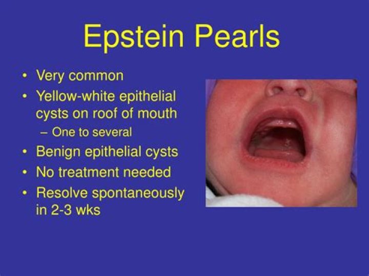 What is an Epstein Pearl?