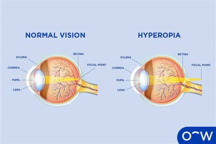What is hyperoptic vision?