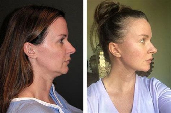 What is ponytail lift?