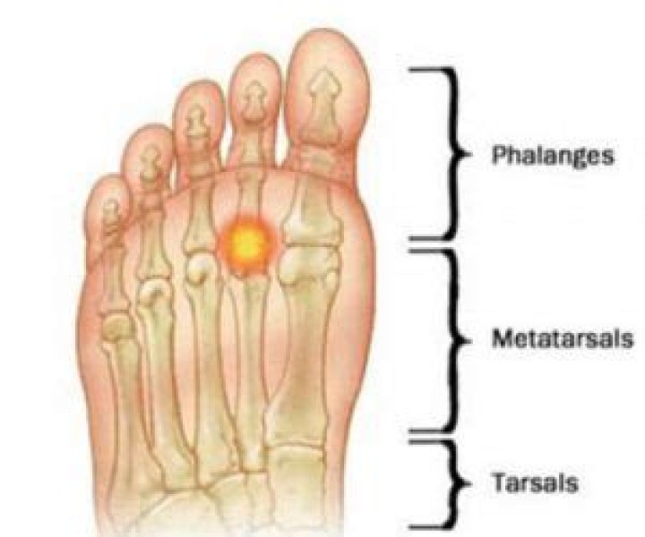 What is synovitis of the foot?