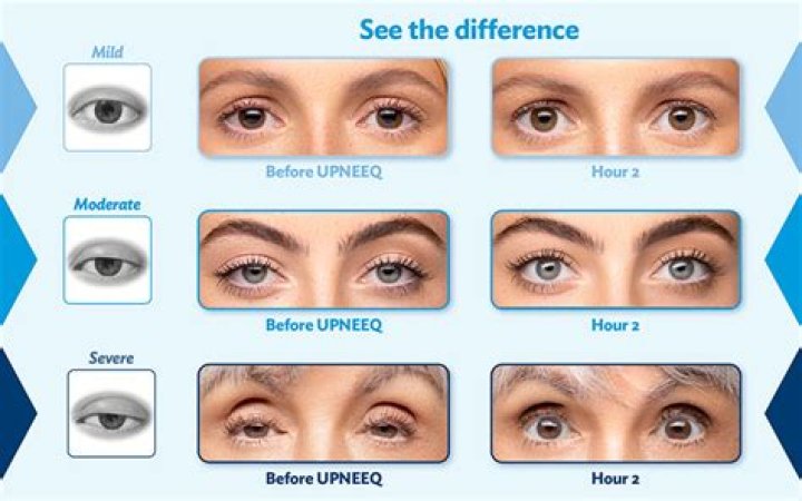 What is the best treatment for saggy eyelids?
