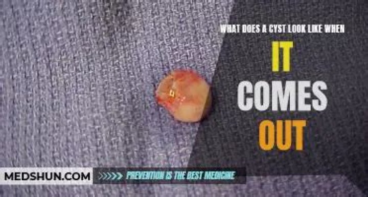 What is the black stuff that comes out of a cyst?