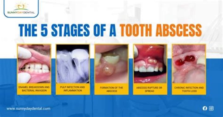 What is the difference between a tooth infection and an abscess?