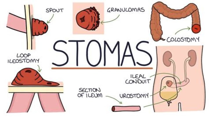 What is the difference between an ileostomy and a colostomy?