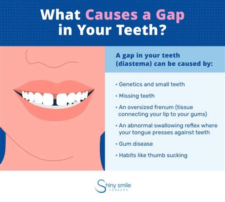 What is the gap in front teeth called?