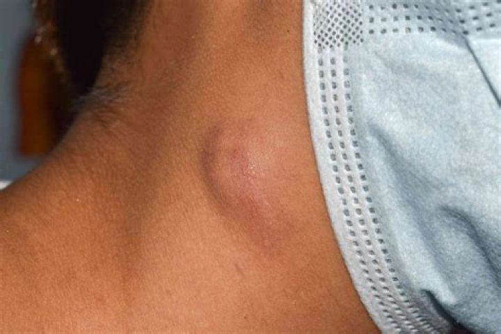 What is the lump in my bum crack?