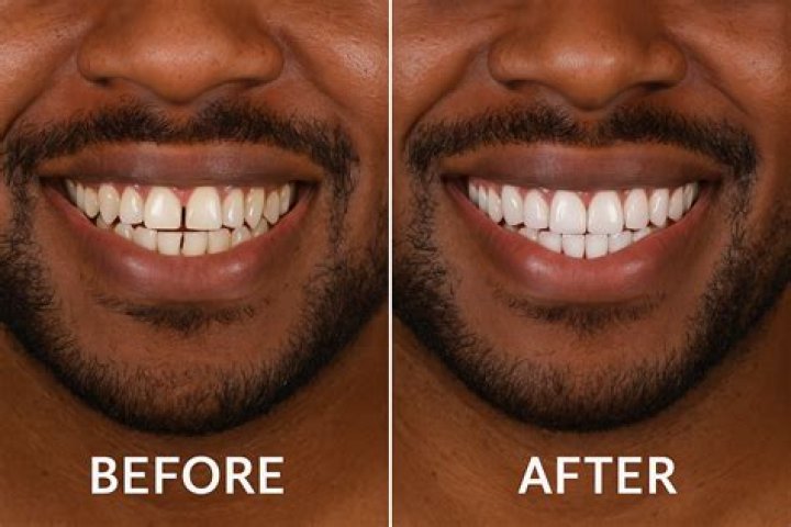 What is the maintenance for veneers?
