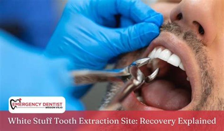 What is the white stuff in my tooth extraction site?