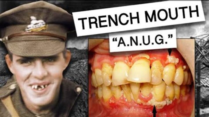 What is trenchmouth?