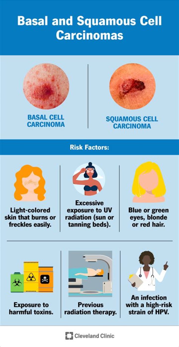 What kills basal cell carcinoma?