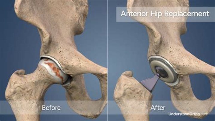 What kind of chair is best after hip replacement?