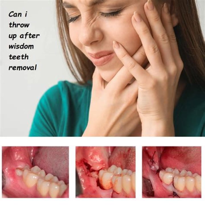 What makes you silly after wisdom teeth?