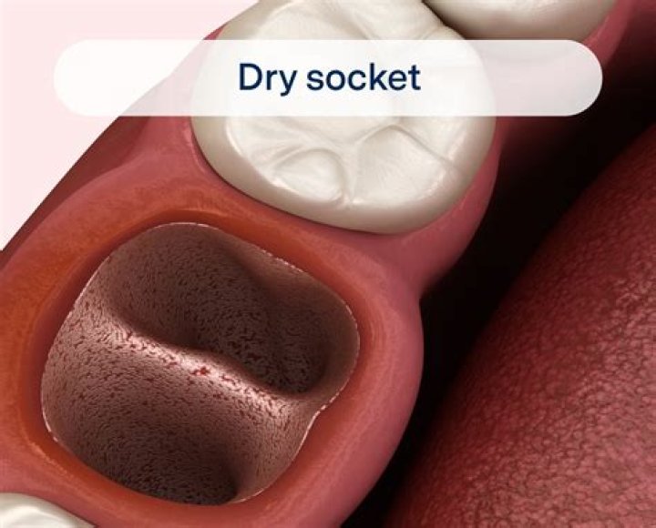 What percentage of wisdom teeth get dry socket?