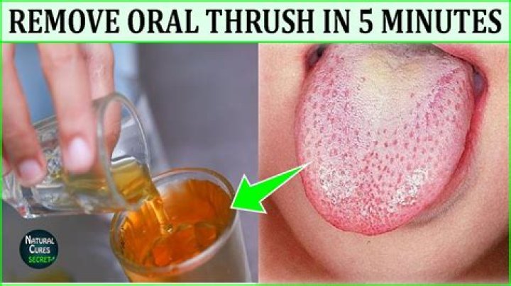 What should I eat with oral thrush?
