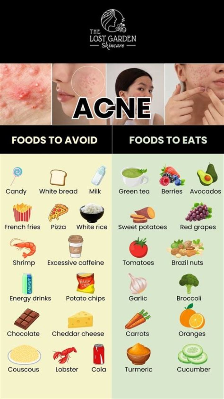 What should you not drink if you have acne?