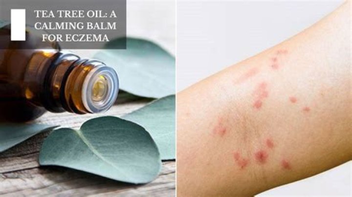 What tea helps eczema?