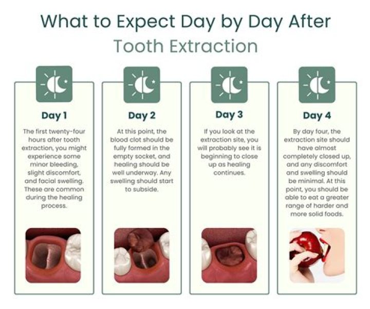 What to expect after full teeth extractions?