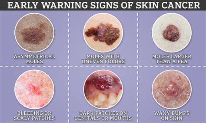 What type of moles are cancerous?