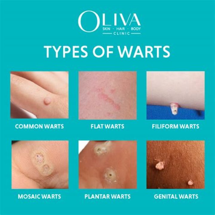 When is a wart no longer contagious?