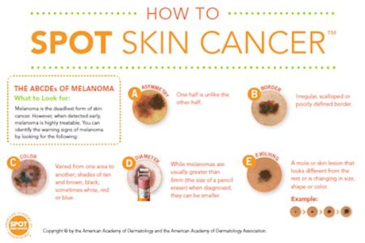 When should I be worried about a mole?