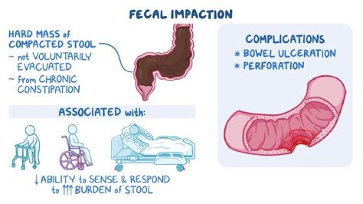 When should I go to ER for impacted bowel?