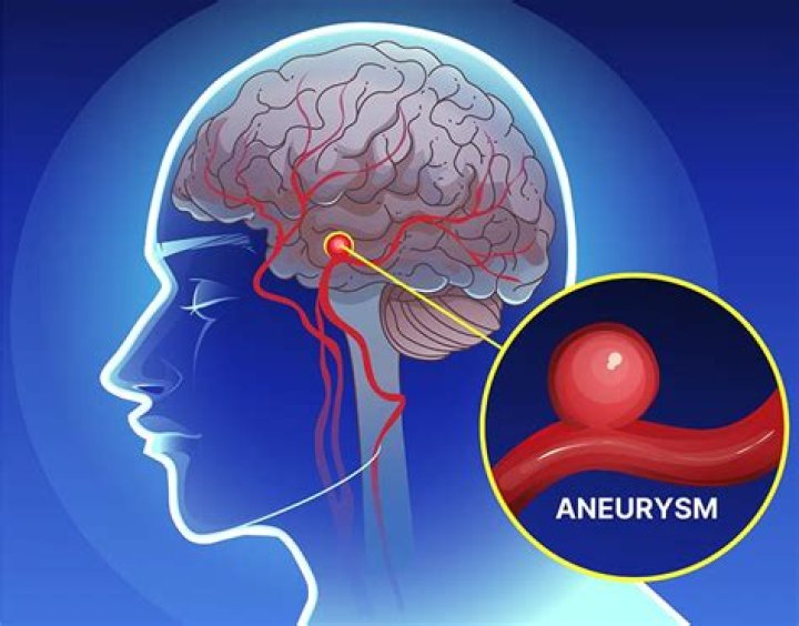 Where do you feel aneurysm?