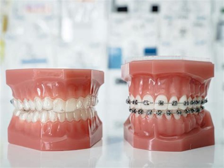 Which is more expensive traditional braces or Invisalign?
