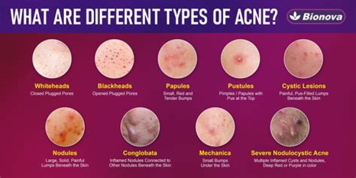 Which race gets the most acne?