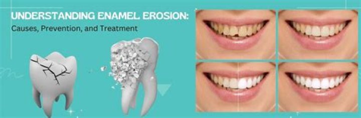 Why am I losing enamel on my front teeth?