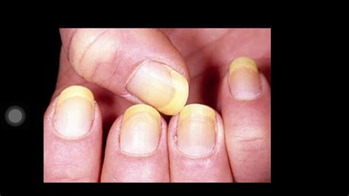 Why are my fingernails yellow?