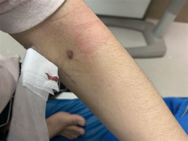 Why can't the nurse get blood from my arm?