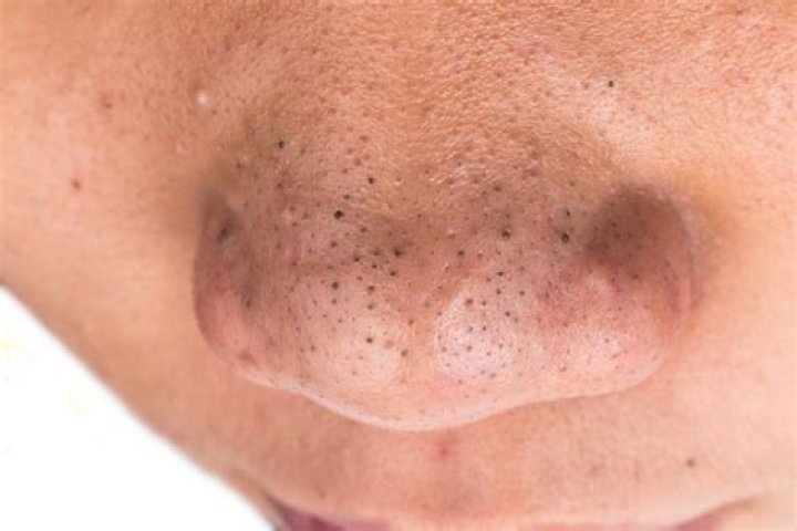 Why do I get blackheads around my lips?