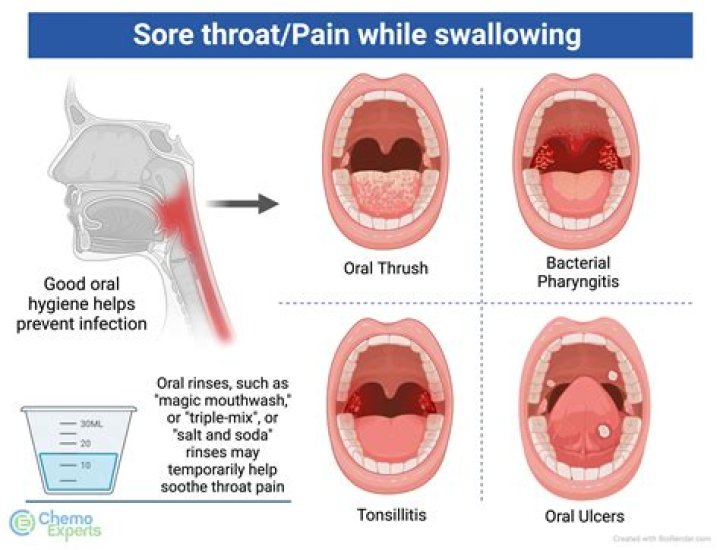 Why do I have a sore throat and no fever?