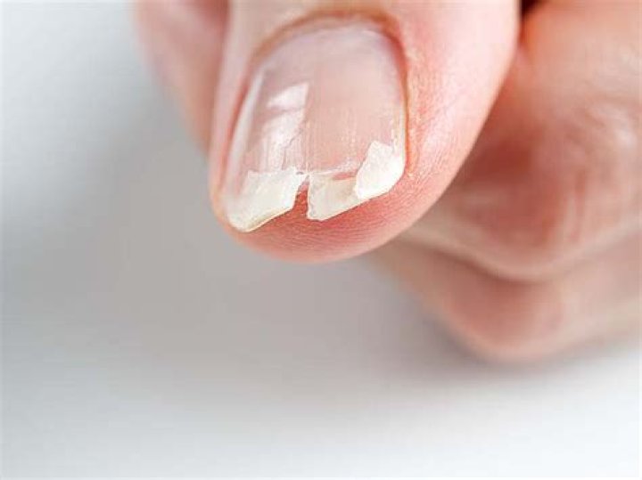 Why do my nails burn when I get acrylics?