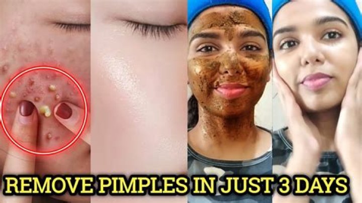 Why do pimples refill after popping?