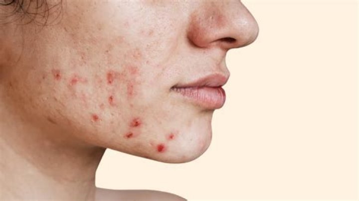 Why do some zits refill?