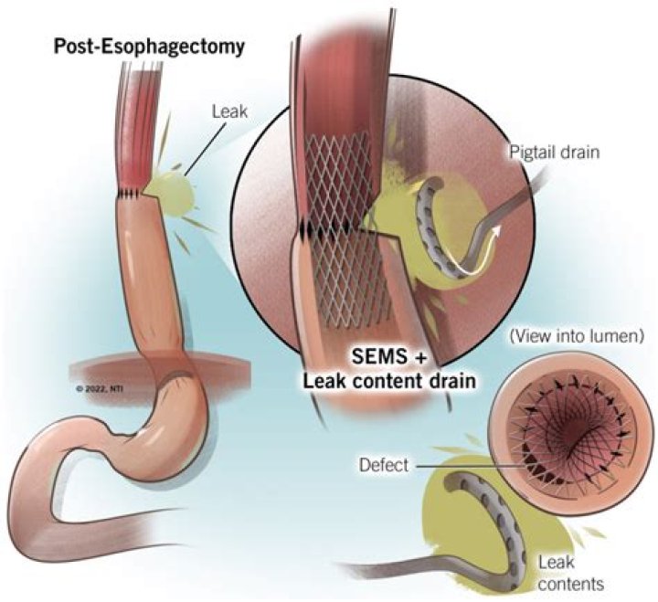 Why do tampons leak when not full?