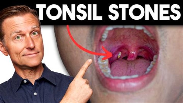 Why do tonsil stones come out randomly?