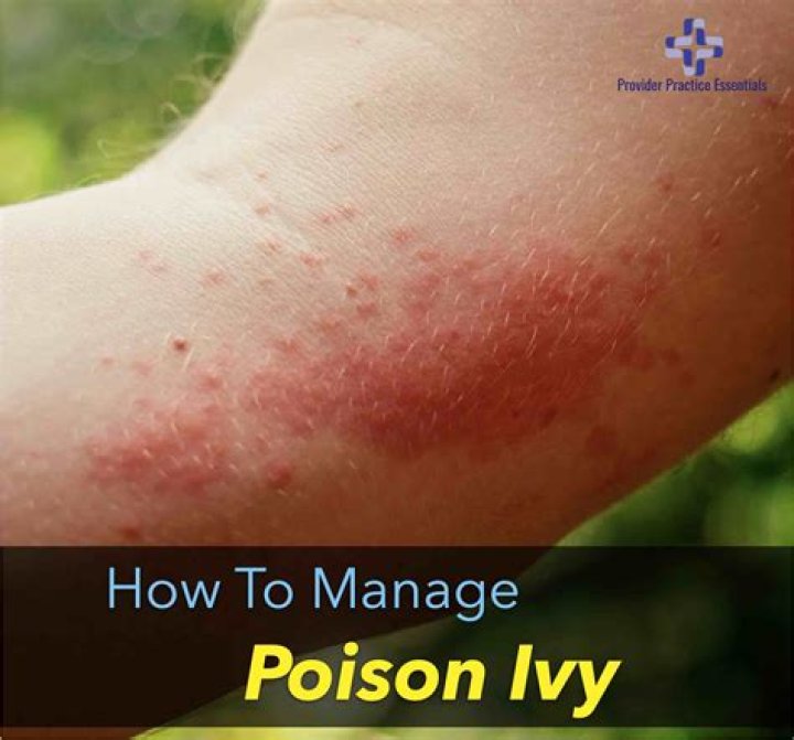 Why does hot water feel so good on poison ivy?