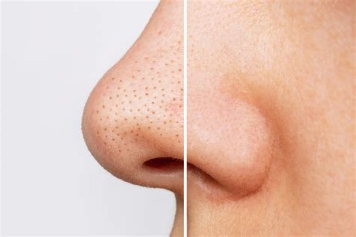 Why does my blackhead keep coming back?