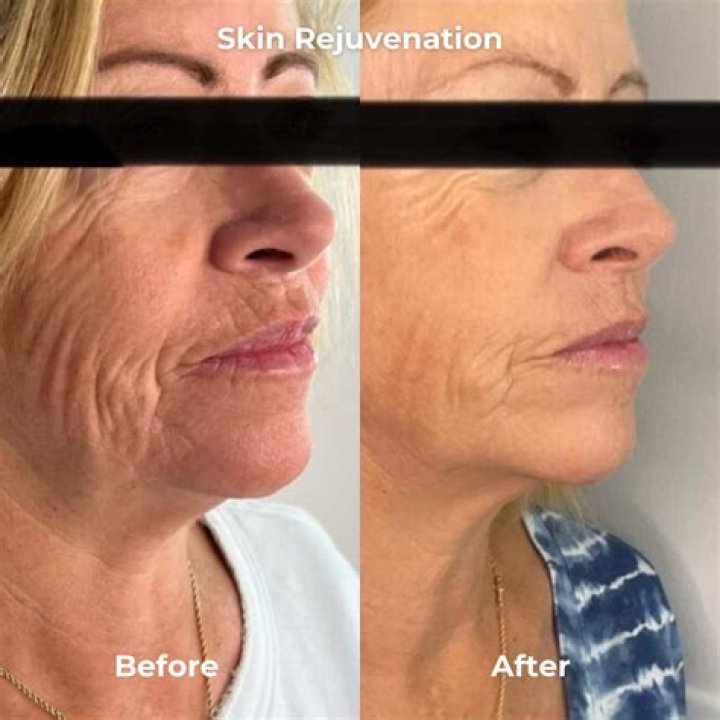 Why does my skin look more wrinkled after microneedling?