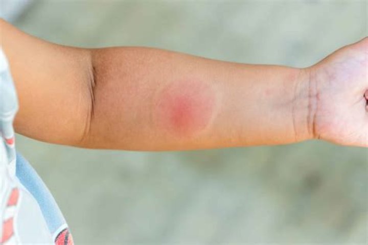 Why is my bug bite big and hot?