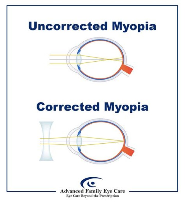 Why Myopes are Undercorrected?