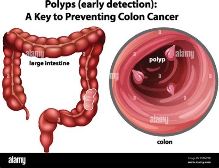 Why would a polyp not be removed during colonoscopy?