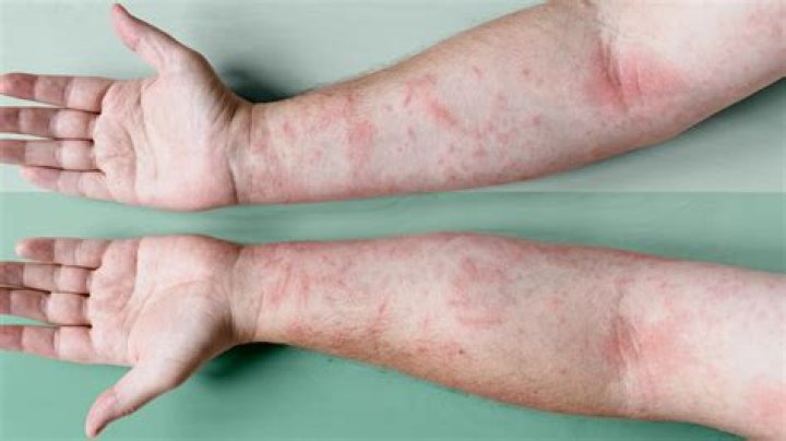 Will eczema go away if left untreated?