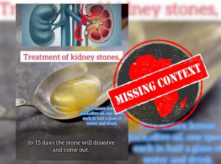 Will lemon dissolve kidney stones?